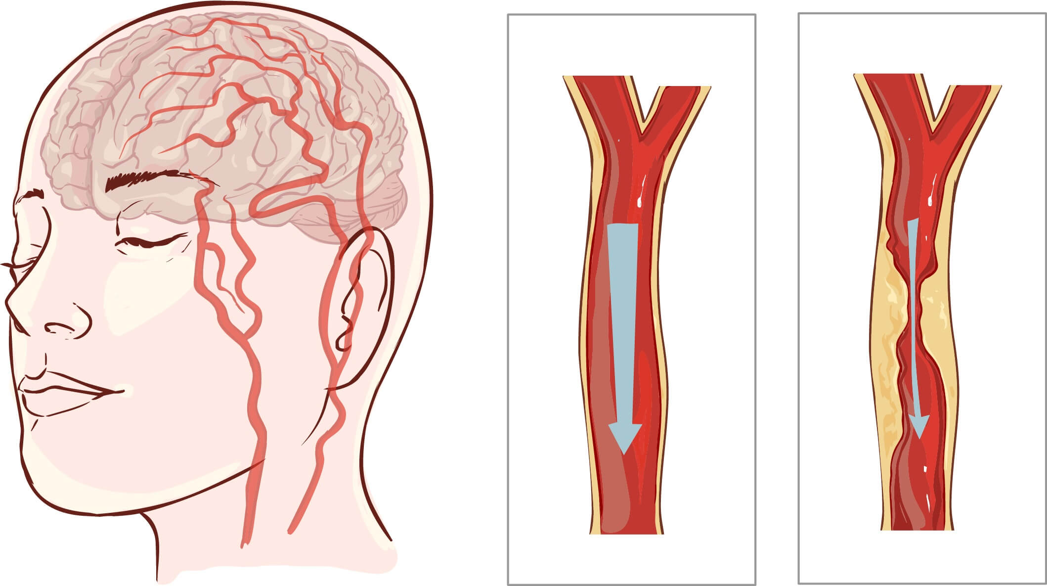 hyperbaric-oxygen-treatment-benefits-for-vascular-dementia-patients