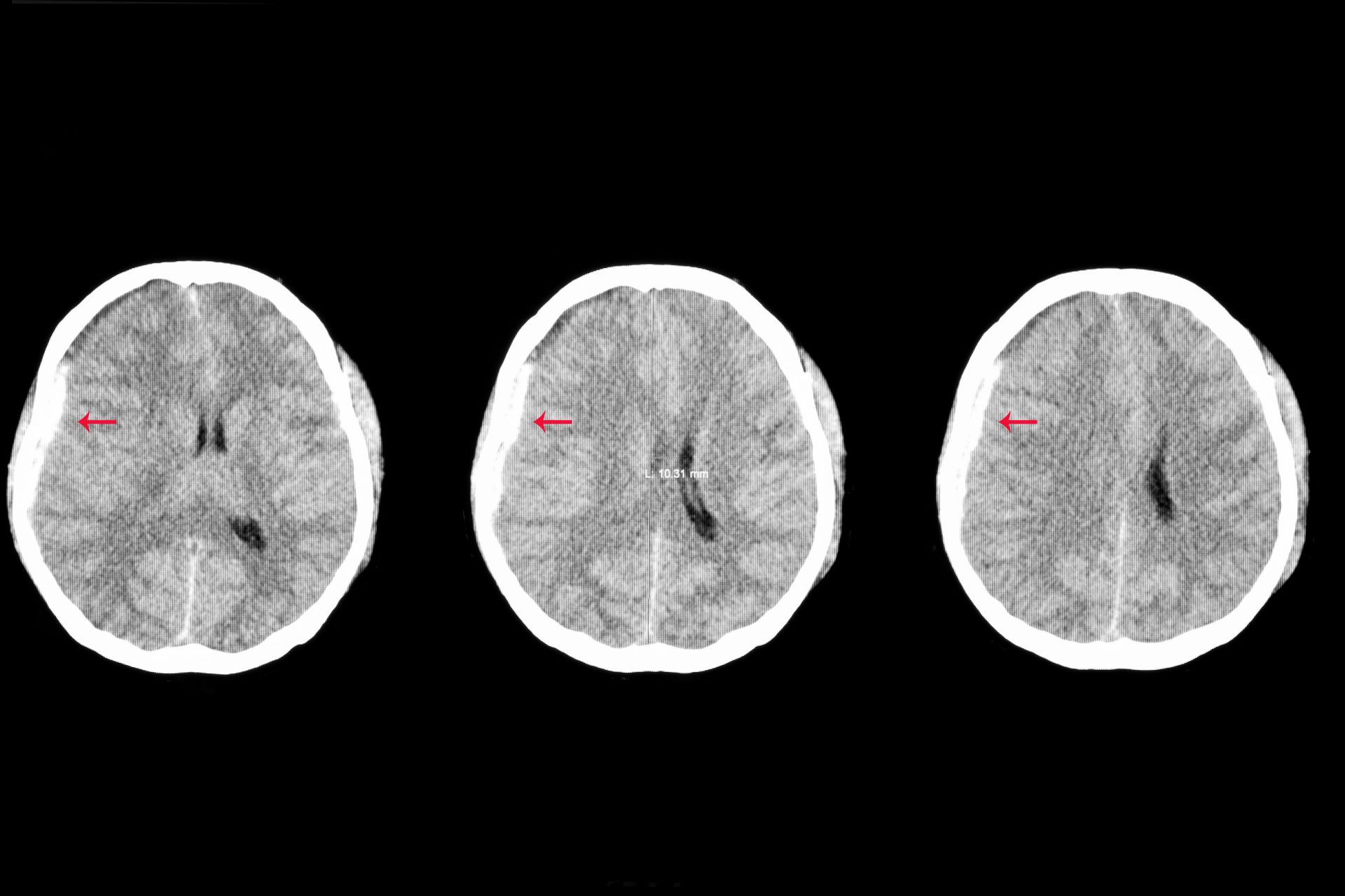 What Does Brain Damage Look Like In Dogs